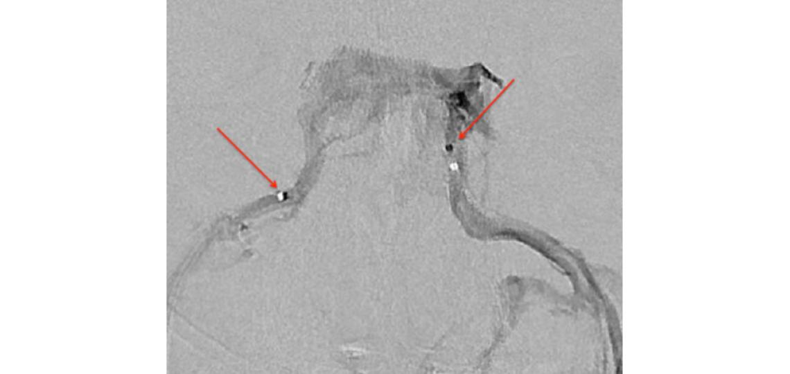 Cerebral venogram outlining bilateral cavernous sinuses and inferior petrosal sinuses. A microcatheter (arrow) is seen in each inferior petrosal sinus.