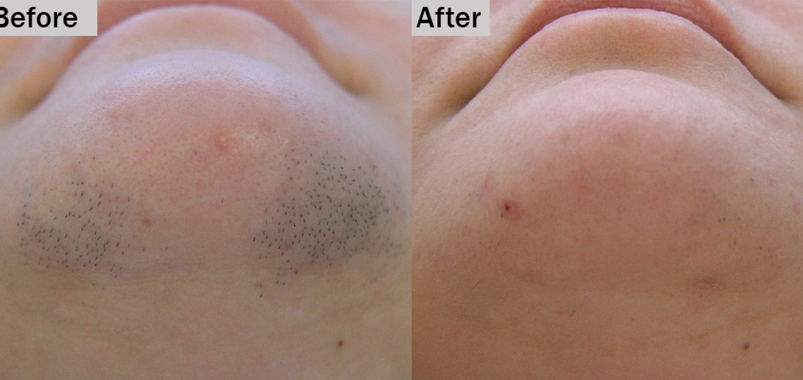best place to get laser hair removal