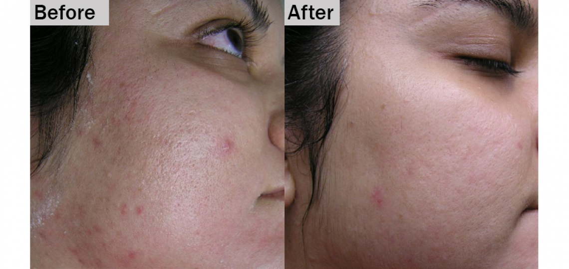 Laser Treatment with the Smoothbeam
