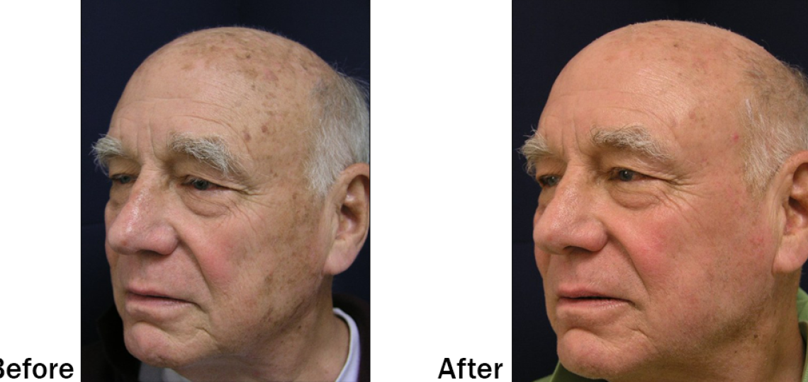 lumenis ultrapulse encore male