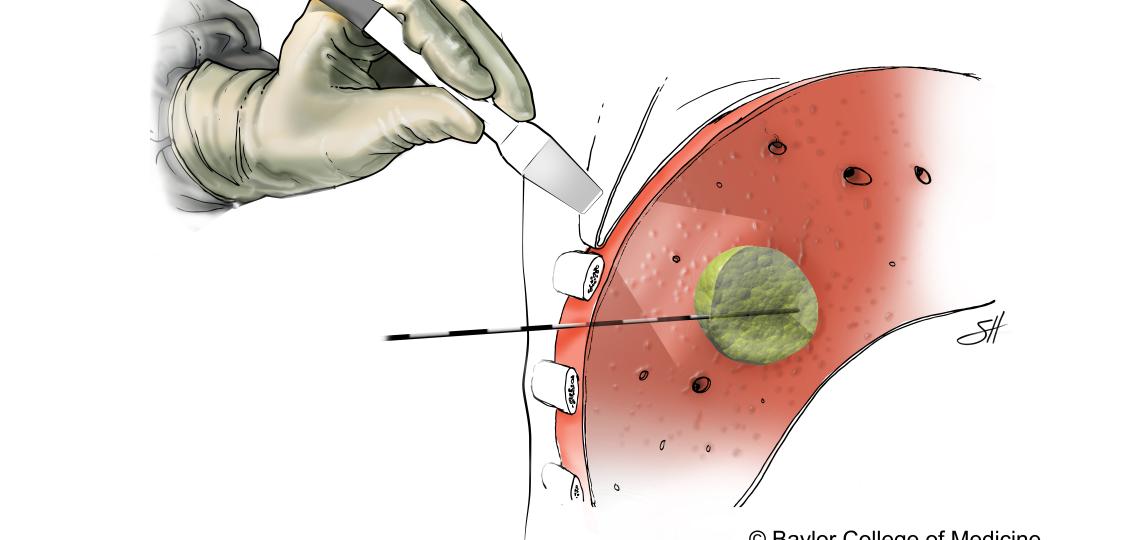 Microwave ablation. Illustration by Scott Holmes