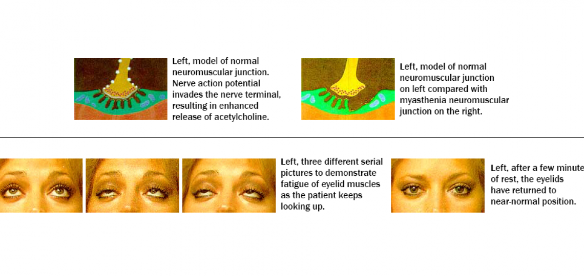 Myasthenia Gravis 2