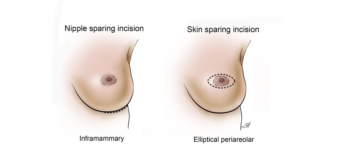 Drawing of nipple and skin sparing mastectomy.