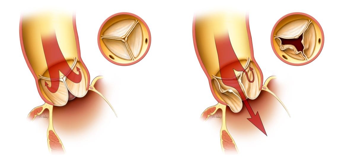 A normal closed valve (left). A leaking valve - called insufficiency or regurgitation (right).