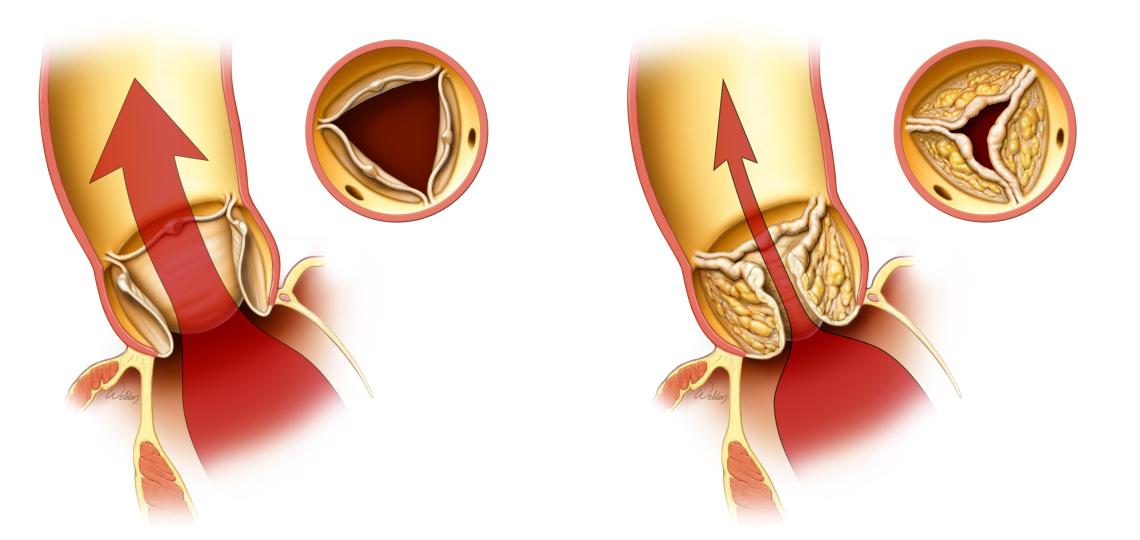 A normal open valve (left). A stenotic valve - partially blocked valve (right).