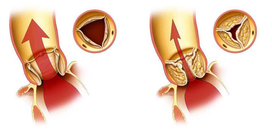 A normal open valve (left). A stenotic valve - partially blocked valve (right).