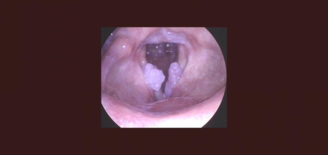 Recurrent respiratory papillomatosis