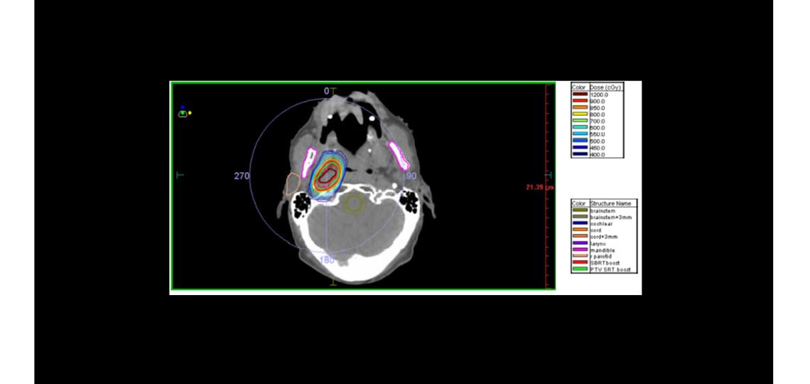 STEREOTACTIC BODY RADIOTHERAPY (SBRT) Dr. Wagner Baylor College of Medicine Houston Texas Medical Ce