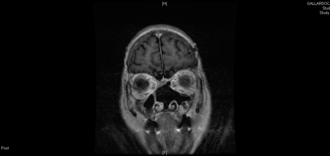 Skull base surgery nose sinus tumors Gallagher Houston Texas Medical Center experts