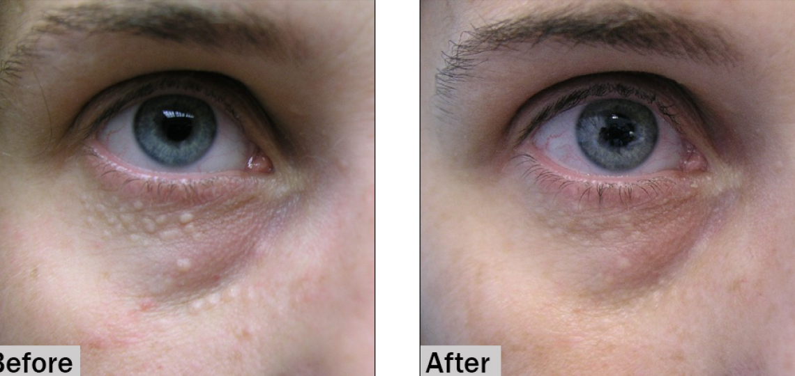 Syringoma, before and after