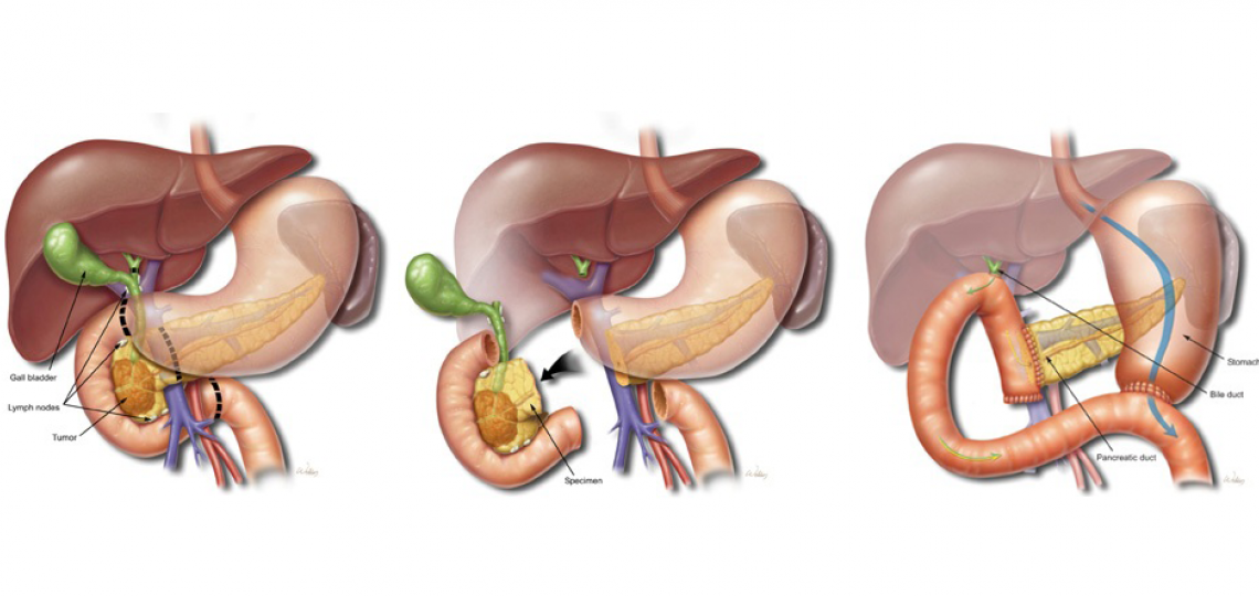 Whipple Procedure Baylor Medicine