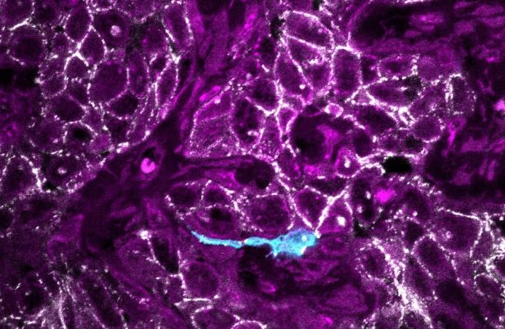 Fluorescent imaging of a Wnt-positive tumor cell (blue) migrating within the tumor landscape