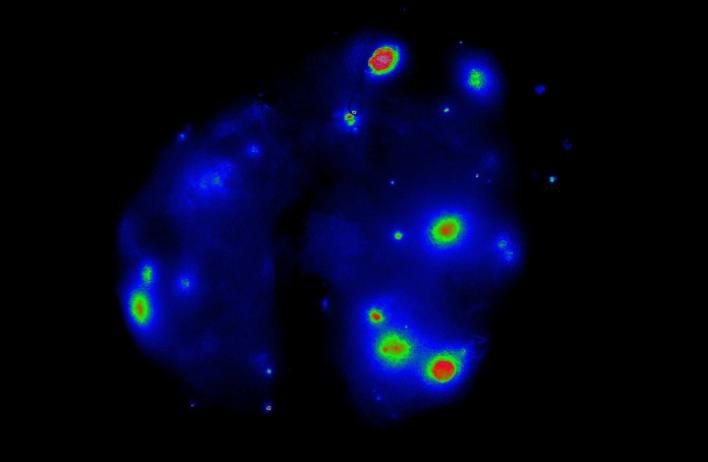 Lung metastases detected by fluorescence imaging