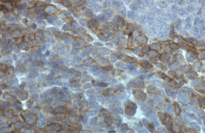 Wnt receptor expression within subpopulations of a breast cancer, detected by immunohistochemistry