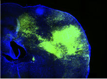 Green fluorescence shows advanced brain tumor growth in mice. 