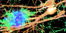 Microscopic images reveal that microglia become activated (green) in response to certain types of toxic amyloid plaques (blue) and damage neurons (gold), leading to defects in learning and memory.