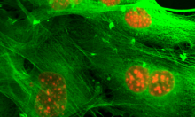 This is a microscopy image of breast cancer cells. Cell nuclei is shown in orange and actin filaments in the cell cytoplasm are stained green.