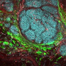 This image of a tumor mass shows cancer cells in teal color.  Macrophages in red and collagen fibers in green form part of the tumor microenvironment. 