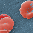 Under a high magnification of 8000X, this scanning electron micrograph (SEM) revealed some of the ultrastructural morphology displayed by red blood cells (RBCs) in a blood specimen of a 6 year old male patient that has sickle cell with hereditary persiste