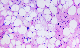 Cancer Cells