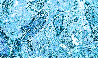Cancerous tissue.