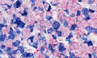 Breast Cancer Cells 