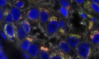 Wide field fluorescence microscopy of human triple-negative breast cancer