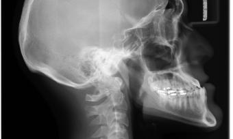 Balck and white x-ray of a person's head and neck, side view