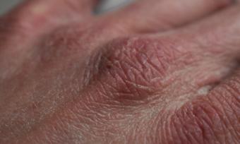 Close up of a hand with dry, cracked skin.