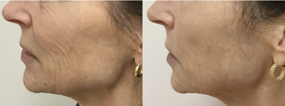 Profound Jowls and Mouth after eight Months