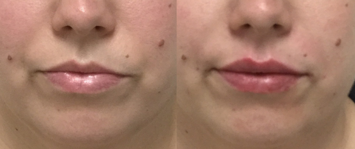 Restylane Before and After