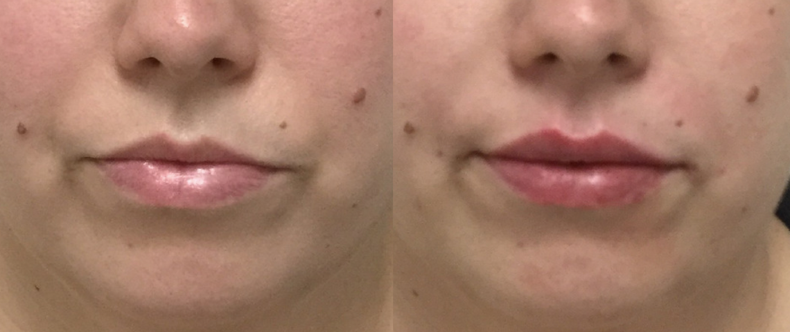 Restylane Before and After