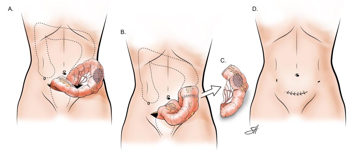 Minimally Invasive Colectomy with Standard Specimen Removal from the Abdomen. This shows the bowel to be brought out through the larger incision and the ends are hooked back up together after the bowel is resected with final incision noted. 