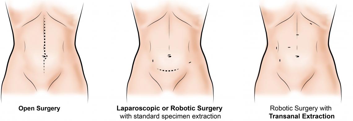Illustration of transanal excision colectomy procedures