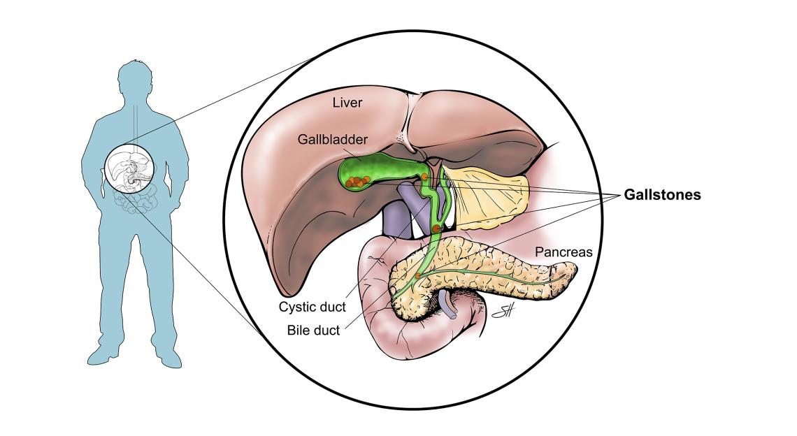 Diagram of gallstones.