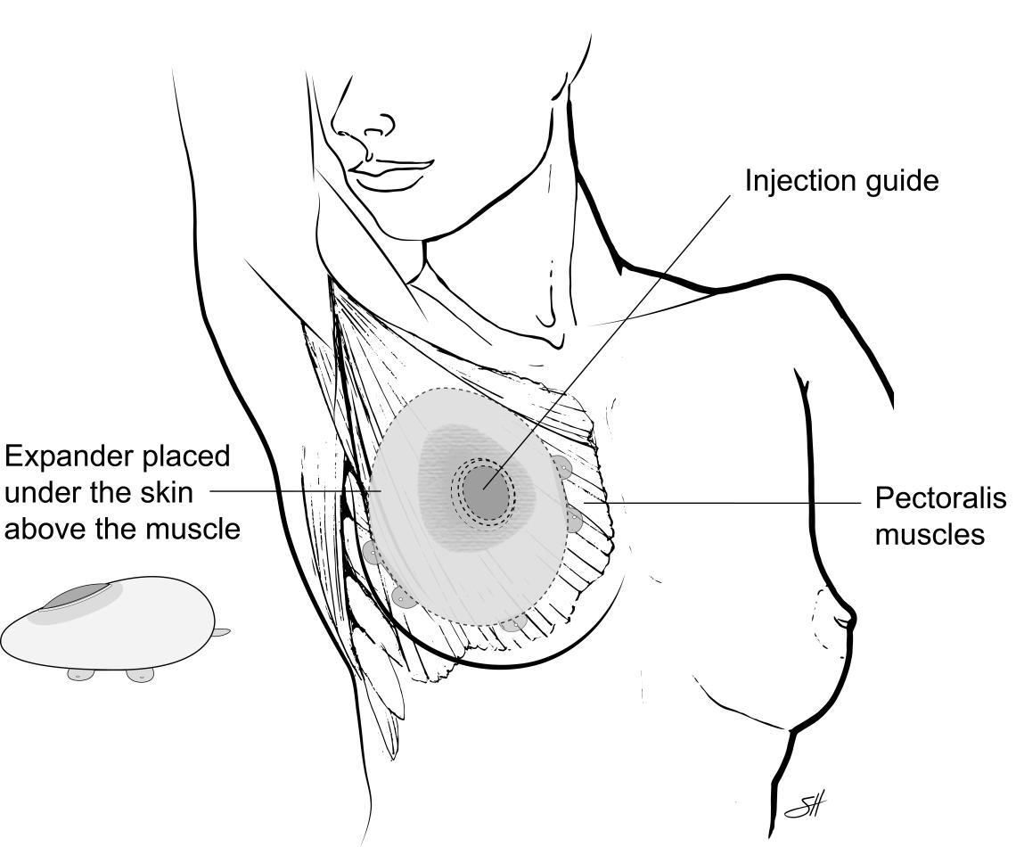Depiction of skin expander placed under the skin and above the muscle.