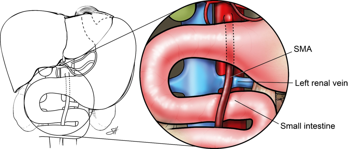 Illustration showing the anatomical relationship between the superior mesenteric artery (SMA), left renal vein, and small intestine. The left side of the image outlines the general position of these organs in the human abdomen, while the magnified section on the right highlights the SMA crossing over the left renal vein and passing anterior to the small intestine. Structures are color-coded for clarity: red for arteries, blue for veins, and pink for the small intestine.