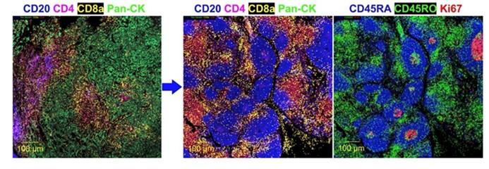 Proteomic determinants of response to checkpoint blockade in malignant pleural mesothelioma 