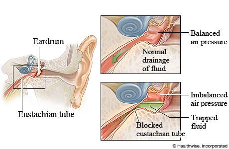 Eustachian Tube Dysfunction