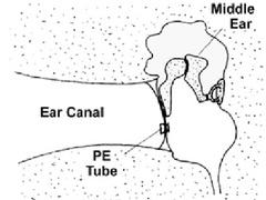 Illustration of the placement of a PE tube between the middle ear and the ear canal