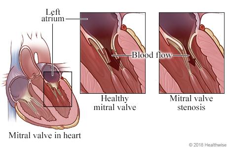 Valve Stenosis