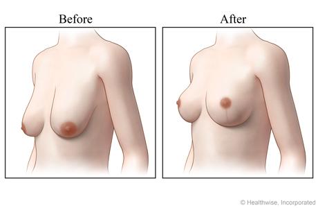 Breast lift 