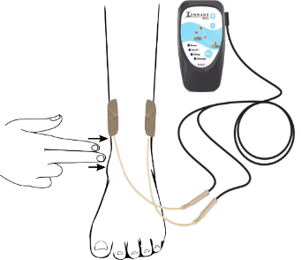 Electrical Stimulation as an Adjunctive Therapy To Accelerate Wound Healing In People With Diabetic Foot Ulcers