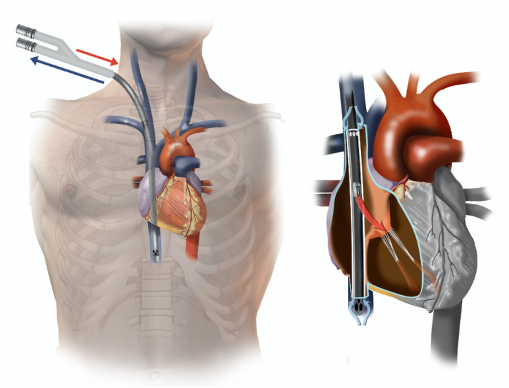 ECMO illustration