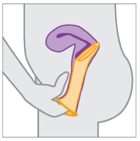 Female Condom