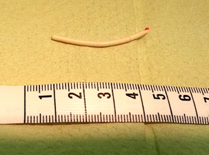 Birth Control Implant