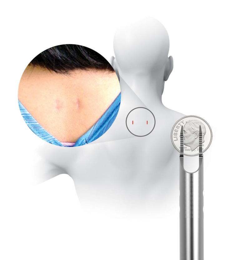 Incision site FUSE study