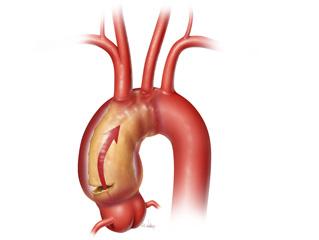A tear or dissection of the ascending aorta (credit: Scott Weldon)