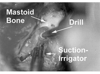 Figure 1: Mastoid bone, drill and suction-irrigator