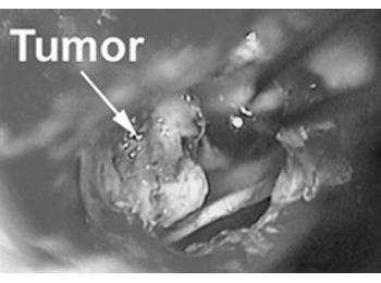 Figure 5: Tumor